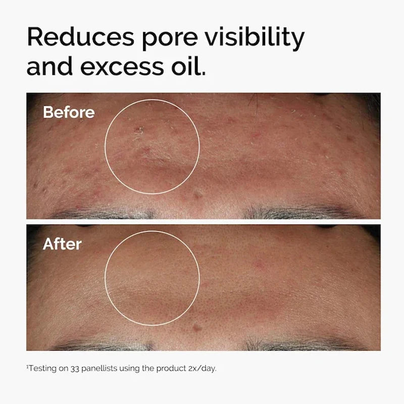 The Ordinary Niacinamide 10% + Zinc 1% Serum results 